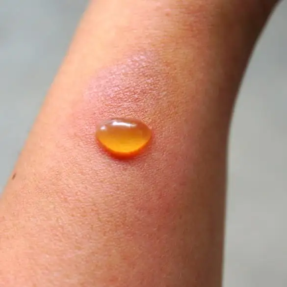 A blister caused by contact between skin and Giant Hogweed's toxic sap